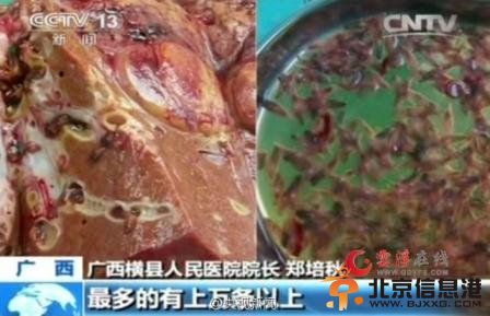 【慎点】男子爱吃淡水鱼生鱼片 肝脏长出百条“肝吸虫”险丧命