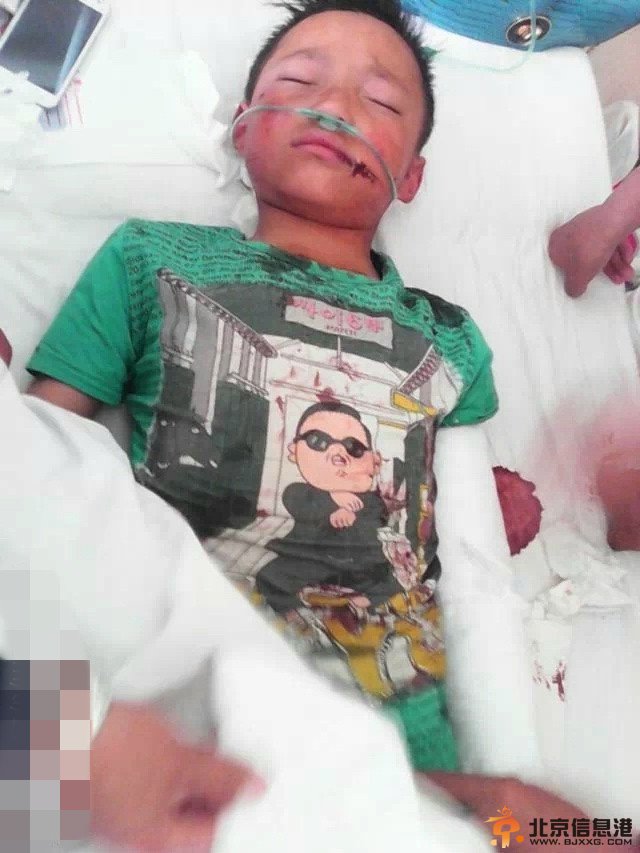 男童遭后母撕嘴挑手筋 多处被划伤