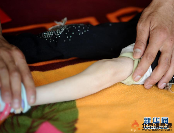 父亲嘴对嘴为患病女儿喂食 坚持500多天(图)