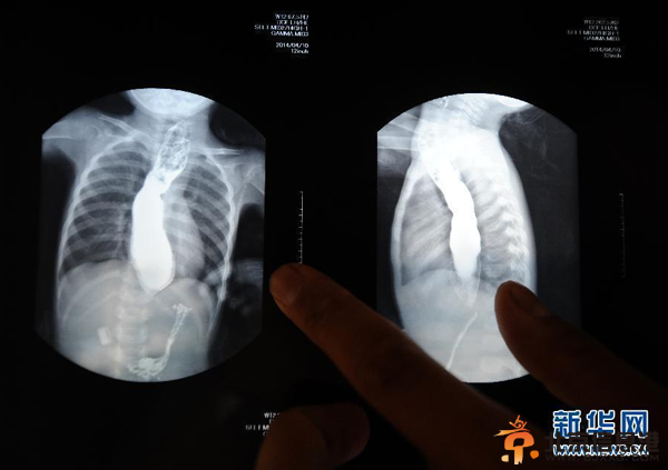 父亲嘴对嘴为患病女儿喂食 坚持500多天(图)