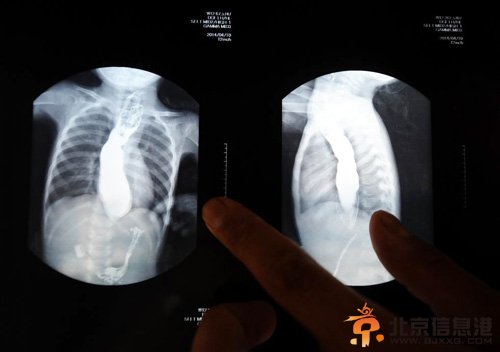 山西父亲嘴对嘴喂食女儿500天 照顾女儿成其他一生责任