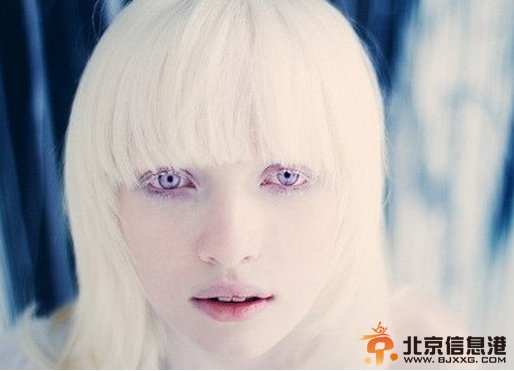 90后白化病女孩求职多次遭拒 白化病人见不得阳光是误解