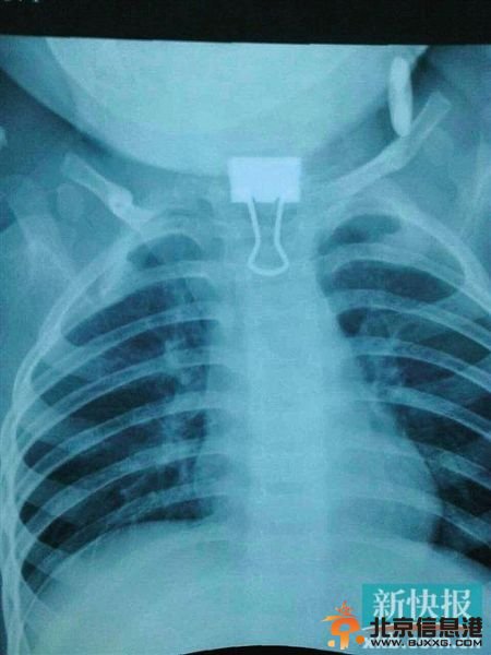 ▲夹子卡在喉咙。 医生成功取出夹子。通讯员供图