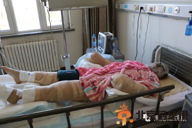 绥化炸鸡店着火店主被救 救人者全身被烧伤(图)