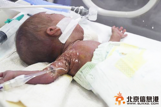 湖北最轻早产儿成活 出生时仅有圆珠笔大小（图）