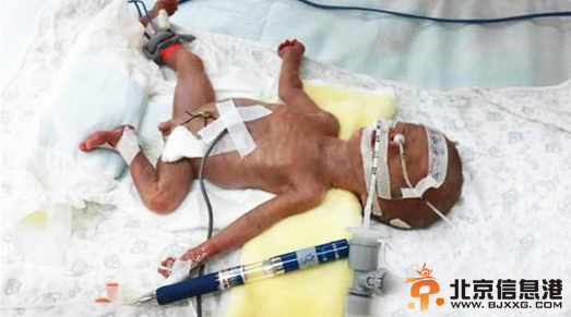 湖北最轻早产儿成活 出生时仅有圆珠笔大小（图）