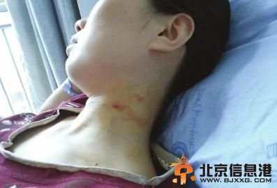 谢晖被掐出的伤