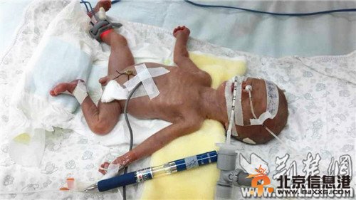 湖北最轻早产儿成活 出生时仅500克身高像圆珠笔