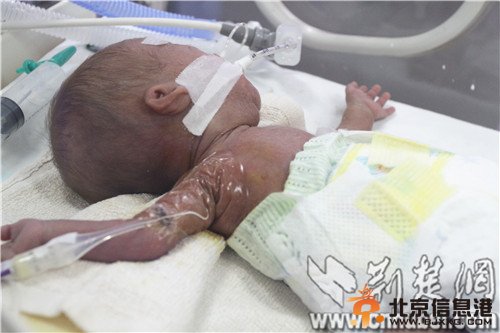 湖北最轻早产儿成活 出生时仅500克身高像圆珠笔