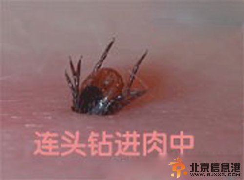 视频：武汉多人被蜱虫咬伤 钻入皮肤被迫挖肉取虫