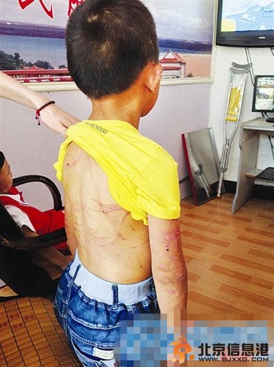 莆田9岁男孩遭母亲长期虐待全身伤痕累累 虎毒尚且不食子