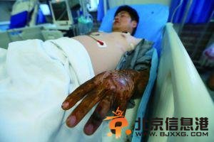 工人夜宿工地遭毒蛇咬伤 无生命危险或有后遗症 