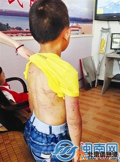 男孩的后背和手臂被母亲打得满是伤痕