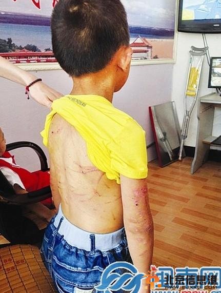 福建莆田男童被母剪耳朵 全身满是伤痕触动众人心