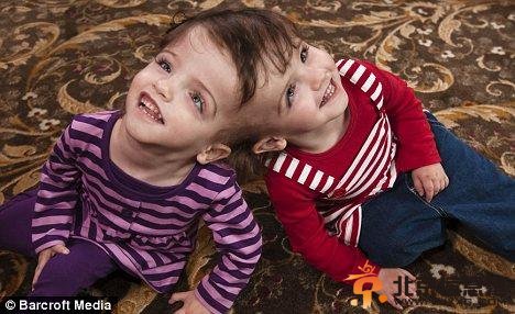 四岁大的连体婴儿塔蒂安娜和克莉丝塔，她们能通过对方的眼睛看世界