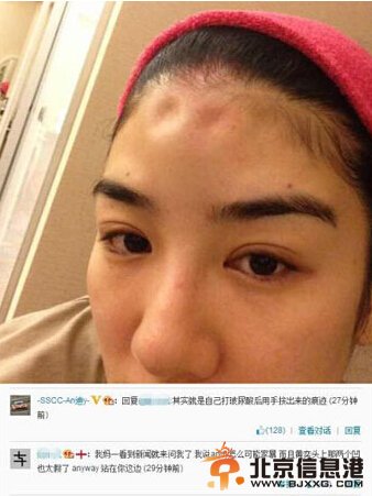 黄奕提出离婚晒被打伤的额头 黄毅清：打玻尿酸捏出来的