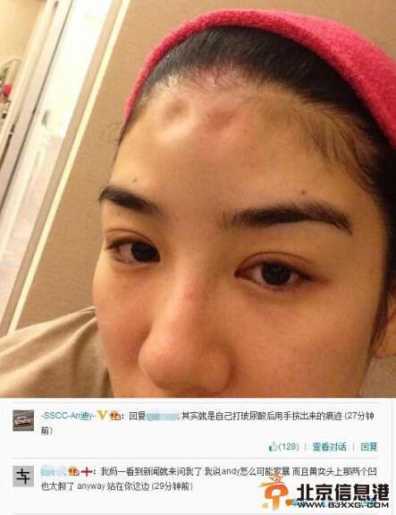 黄奕老公黄毅清家暴真相狗血：黄奕额头被打凹系玻尿酸后用手按的痕迹