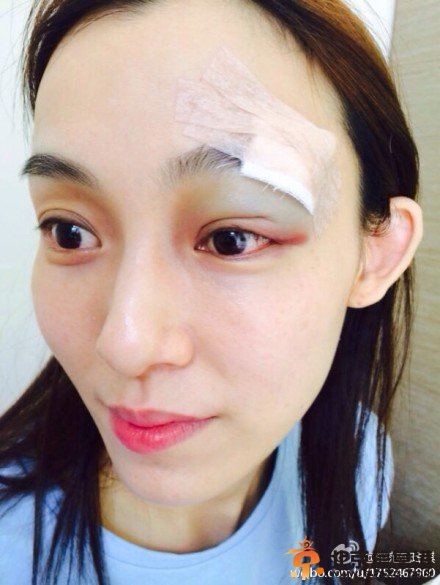范玮琪上厕所被摔毁容照片 满脸鲜血缝20针
