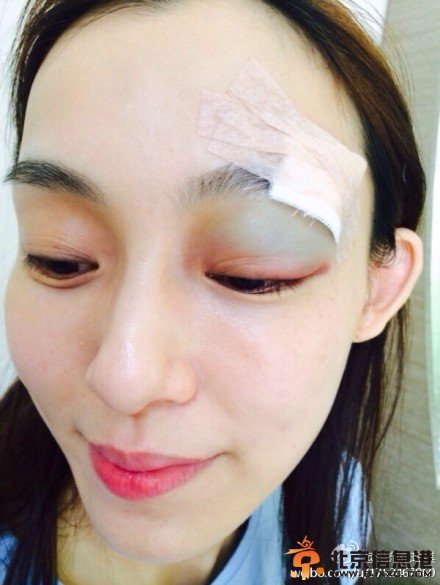 范玮琪上厕所被摔毁容照片 满脸鲜血缝20针