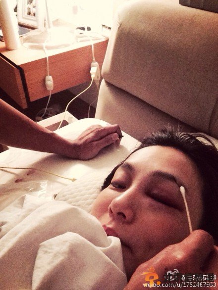 范玮琪上厕所被摔毁容照片 满脸鲜血缝20针