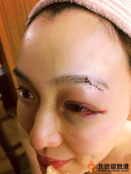 范玮琪摔倒左眼缝20多针 网友：这是要家暴的节奏吗