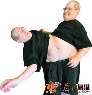 美62岁连体双胞胎欲创“最长寿”纪录