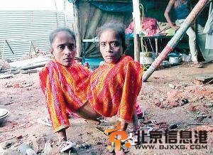 印度连体姐妹结婚生子 丈夫宣称深爱着这两个“蜘蛛女”
