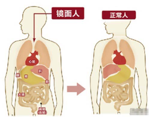【镜面人】老伯体内脏器全长反成罕见镜面人 揭镜面人和正常人有哪些不同
