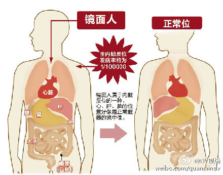 镜面人：老伯基因突变成 内脏竟然是相反的