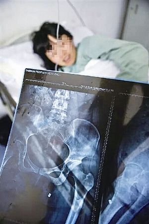 女子娘家阳台遭枪击 屁股被钢珠弹爆开了花【图】