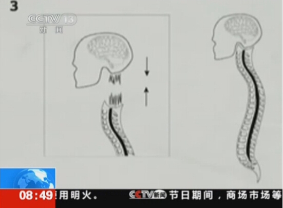 意大利首例人类“换头手术”将实施 估计需36小时才能完成