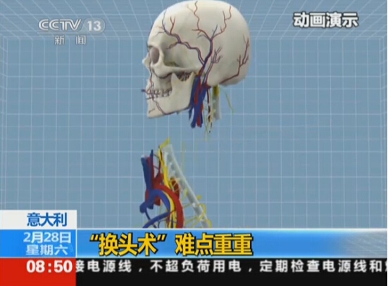 意大利首例人类“换头手术”将实施 估计需36小时才能完成